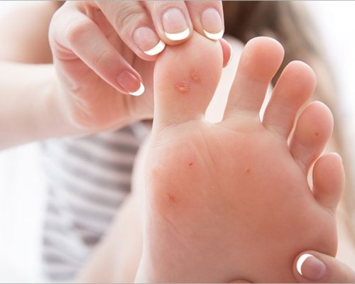 Wart, Mole & Corn Care in Roorkee